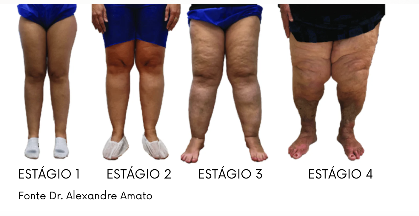 Capa do vídeo Classificação do lipedema — Dr. André Colaneri, lipedema em Uberlândia MG