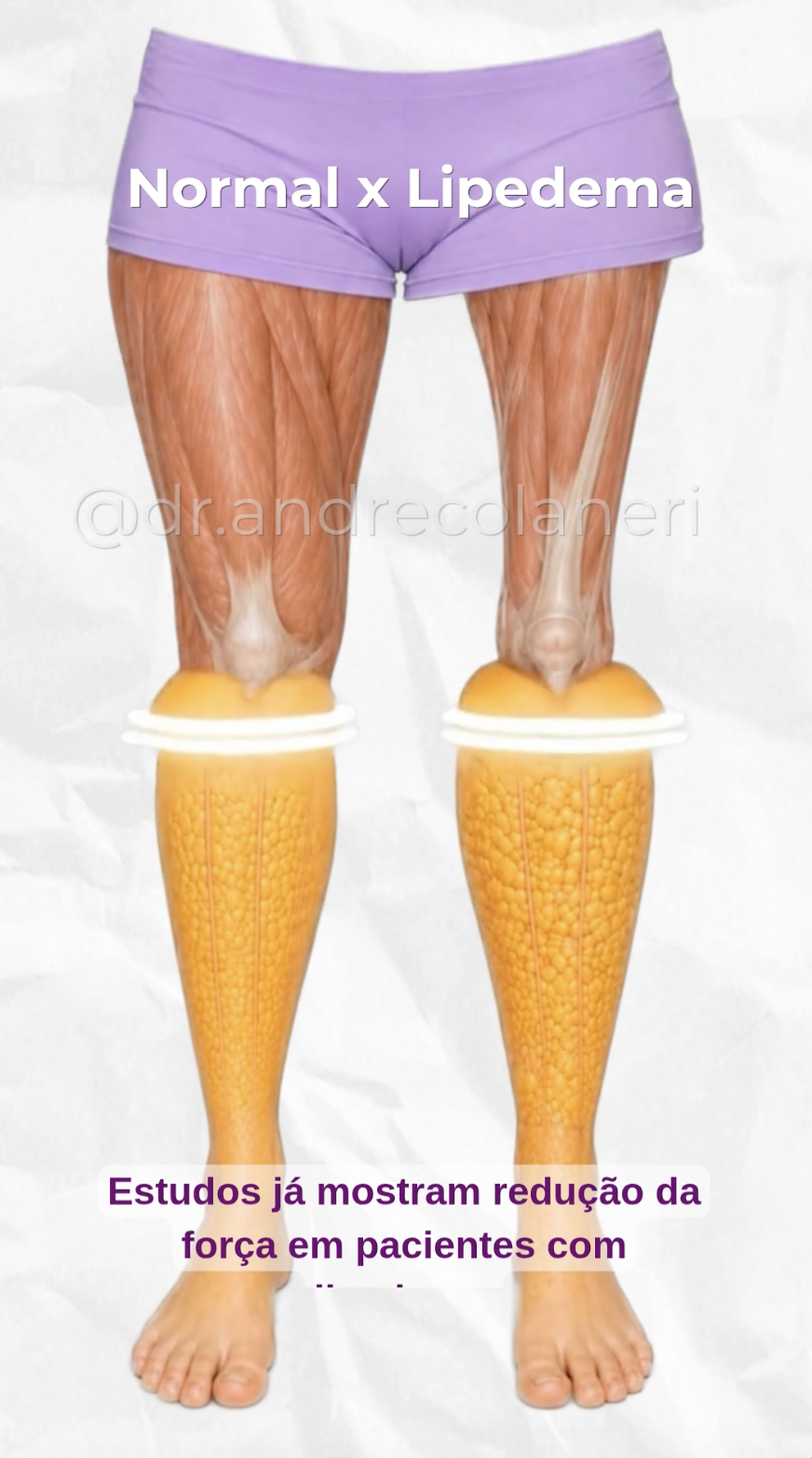 Capa do vídeo Normal x lipedema: redução da força muscular — Dr. André Colaneri, lipedema em Uberlândia MG