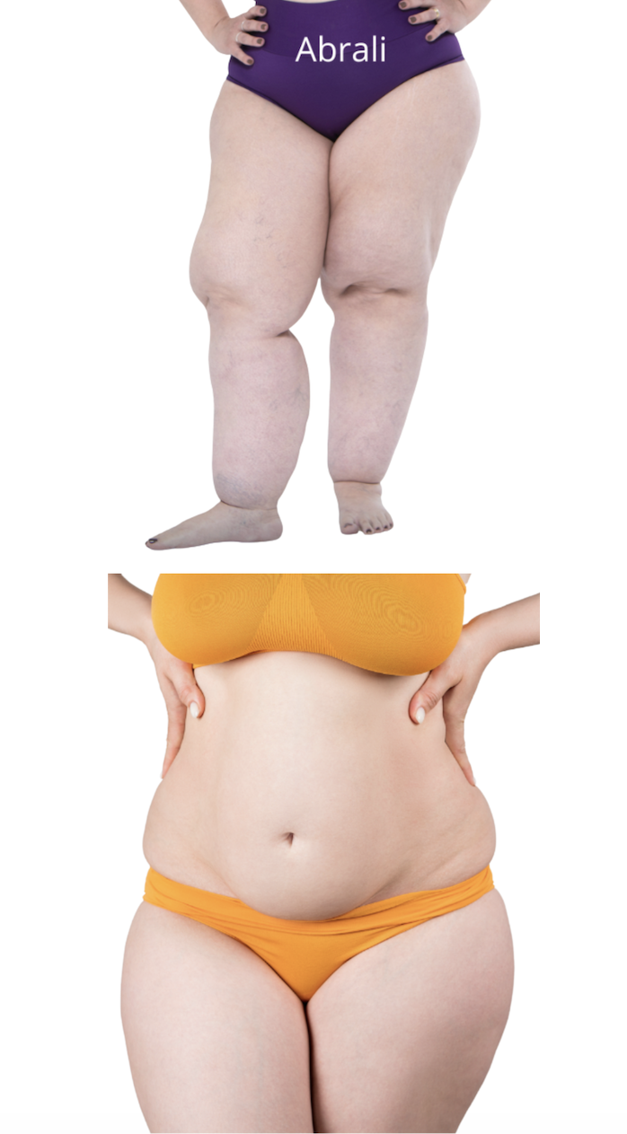 Capa do vídeo Obesidade e lipedema — Dr. André Colaneri, lipedema em Uberlândia MG