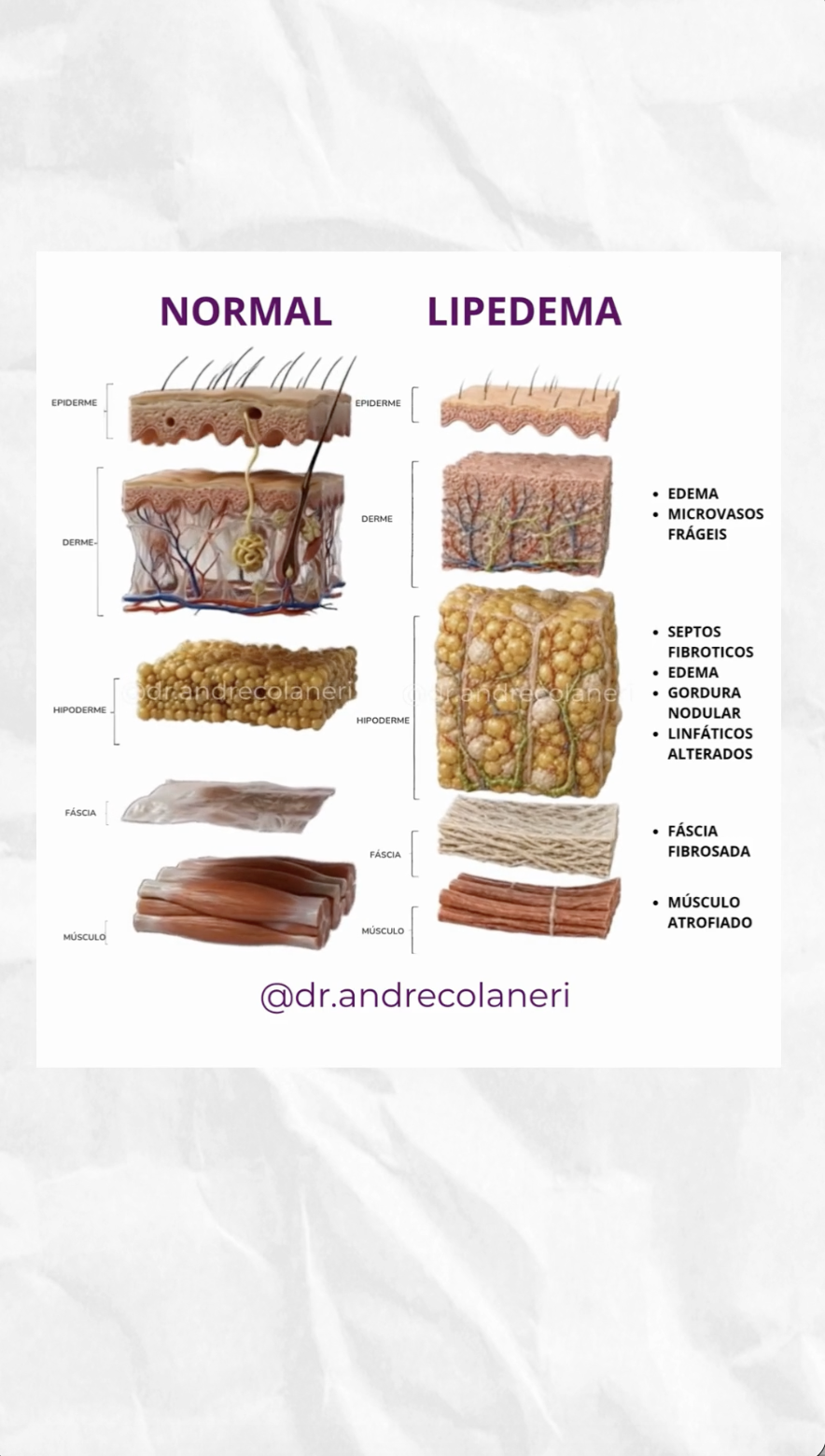 Capa do vídeo Camadas da pele: normal x lipedema — Dr. André Colaneri, lipedema em Uberlândia MG