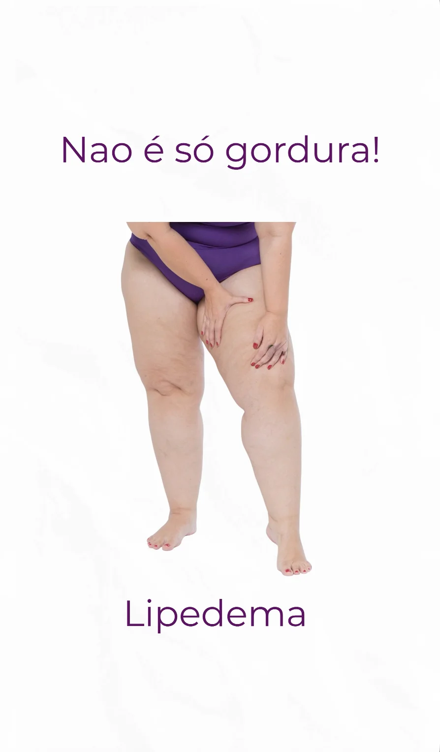 Capa do vídeo O que é lipedema — Dr. André Colaneri, lipedema em Uberlândia MG