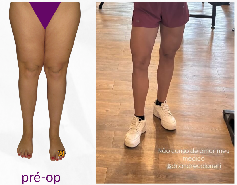 Antes e depois da lipoaspiração para lipedema — caso 1