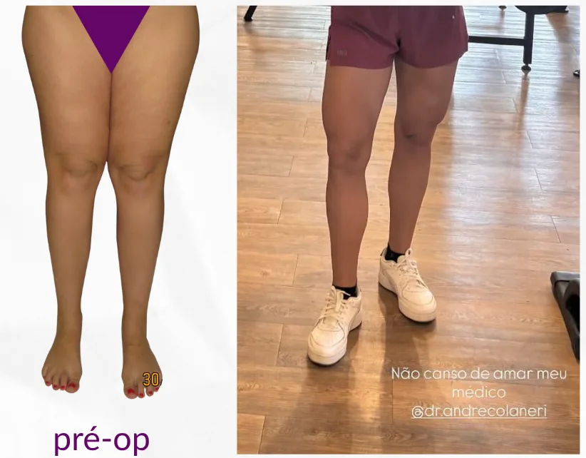 Antes e depois da lipoaspiração para lipedema — caso 1