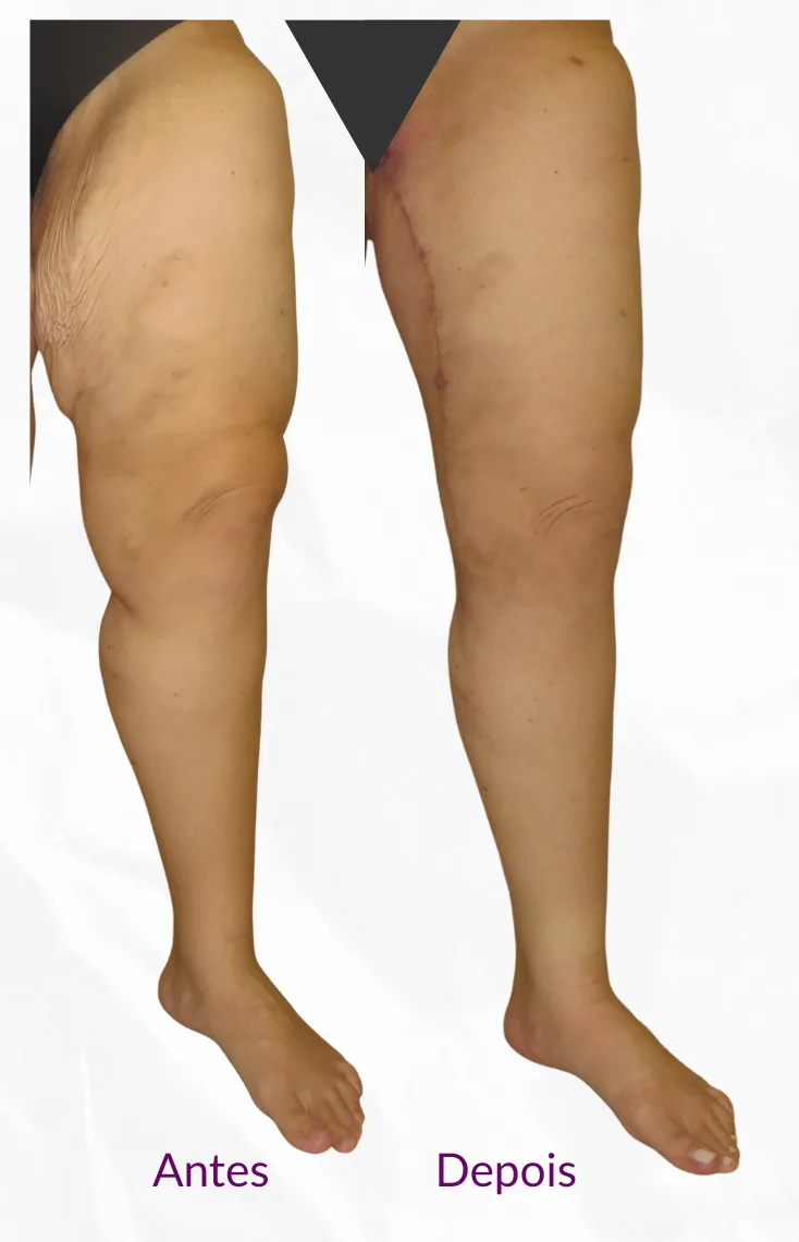 Antes e depois da lipoaspiração para lipedema — caso 2