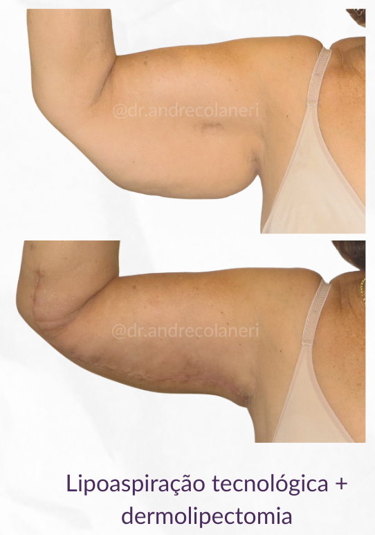 Antes e depois da lipoaspiração para lipedema — caso 3