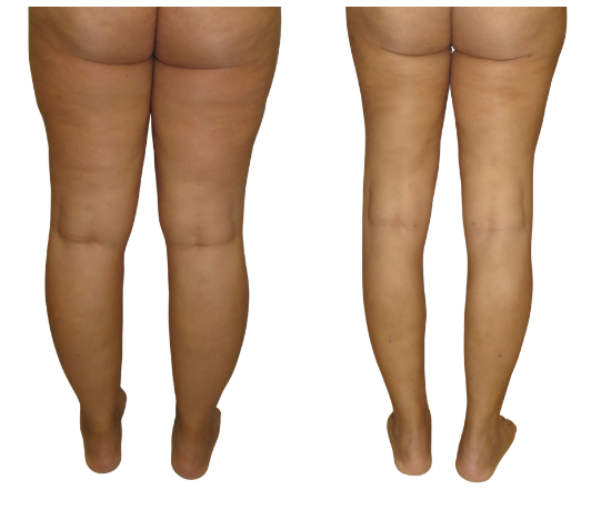 Antes e depois da lipoaspiração para lipedema — caso 4
