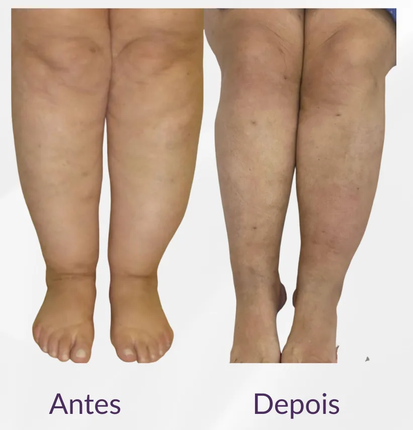 Antes e depois da lipoaspiração para lipedema — caso 5